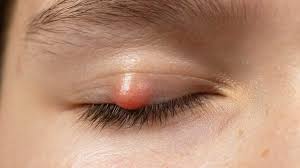 Chalazion