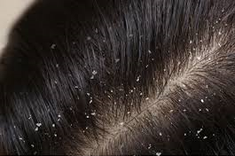 Dandruff 