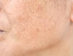 Melasma