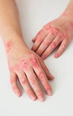 Psoriasis