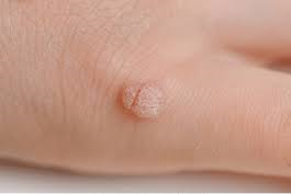 Warts Psoriasis